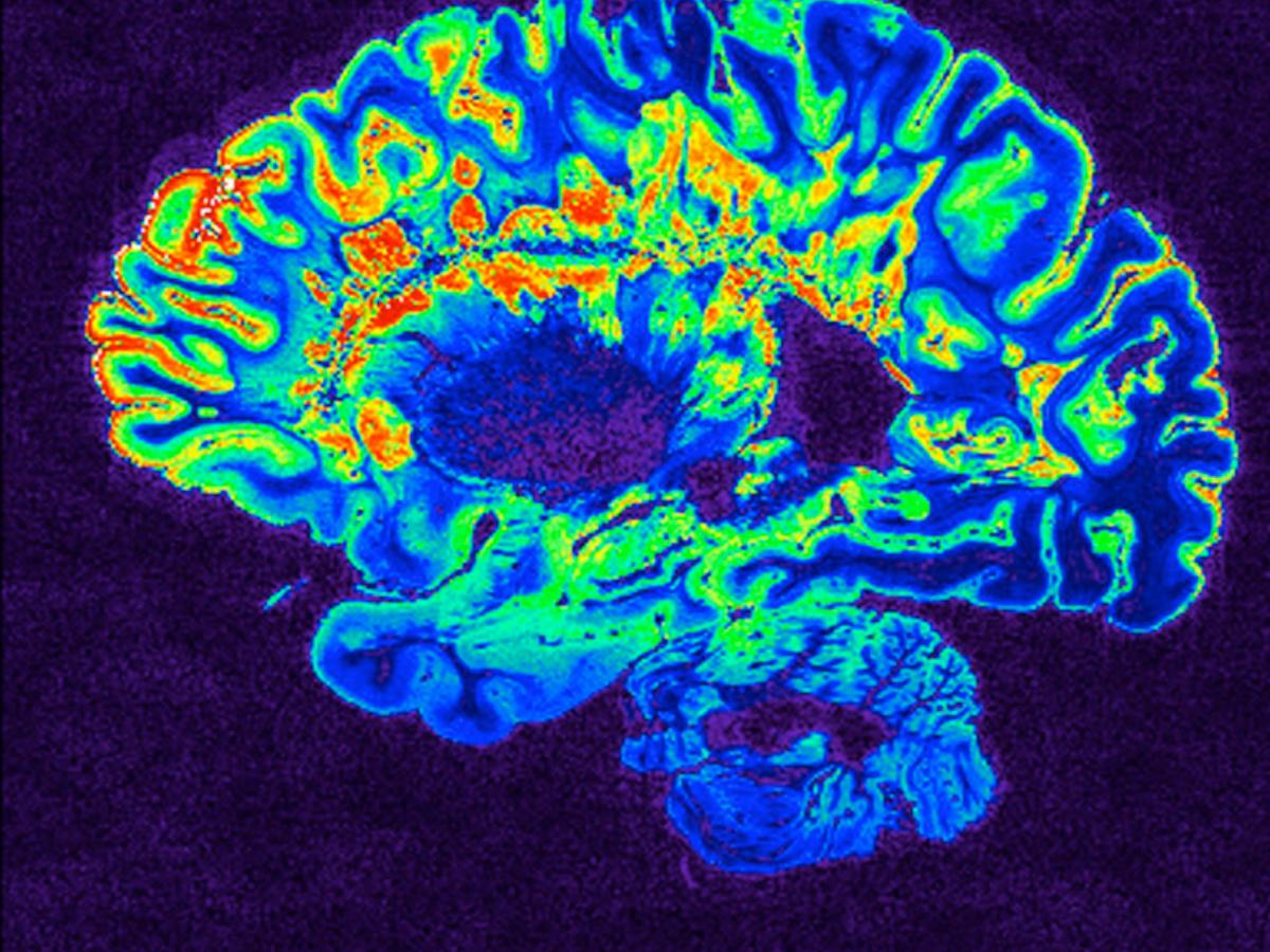Understanding Multiple Sclerosis&nbsp;(MS)